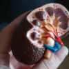 kidney Stones Graphic