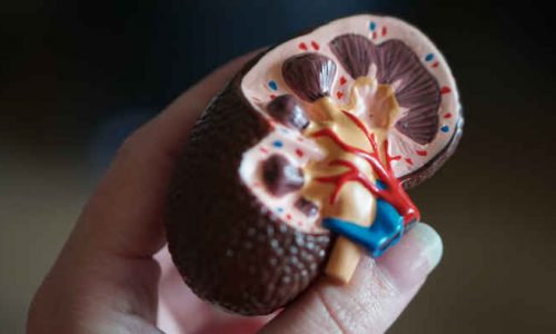 kidney Stones Graphic